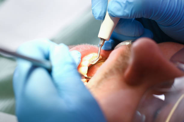 Best Urgent Care for Lost Fillings or Crowns in Rock Island, IL
